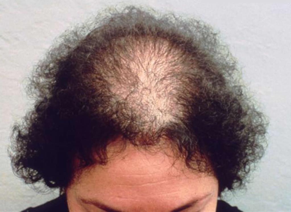 Androgenetische Alopezie bei Frauen