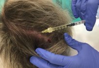 Androgenic alopecia in women and men: causes, treatment and consequences