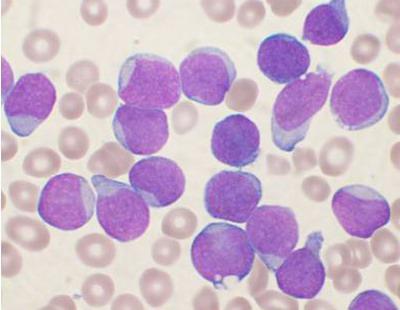 Disease lymphocytic leukemia