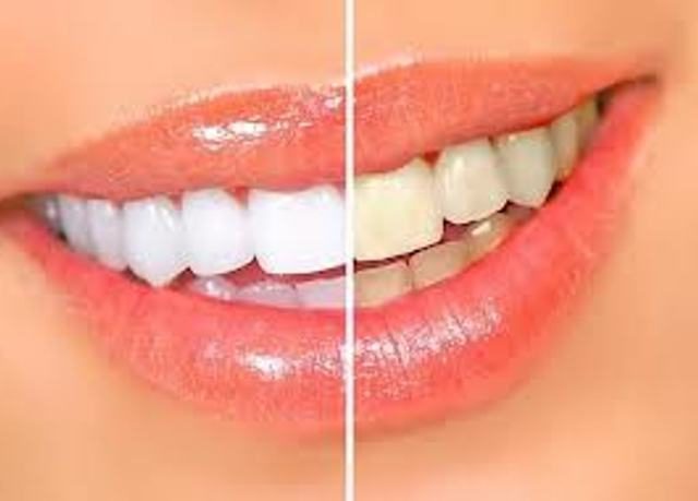 تبييض الأسنان بيروكسيد الهيدروجين