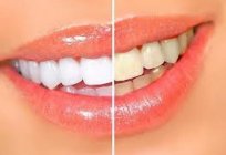 独立した歯を白化過酸化水素水です。