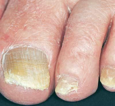 the signs of nail fungus on feet