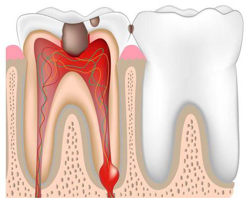 leczenie kanałowe a ząb boli