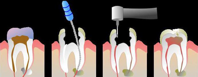 boli czy usunąć nerw z zęba