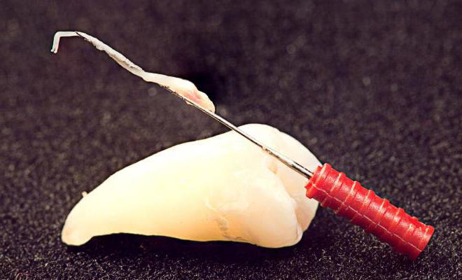 wie zu entfernen den Nerv aus dem zahn