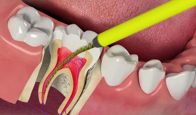 ¿por qué el diente necesita un nervio