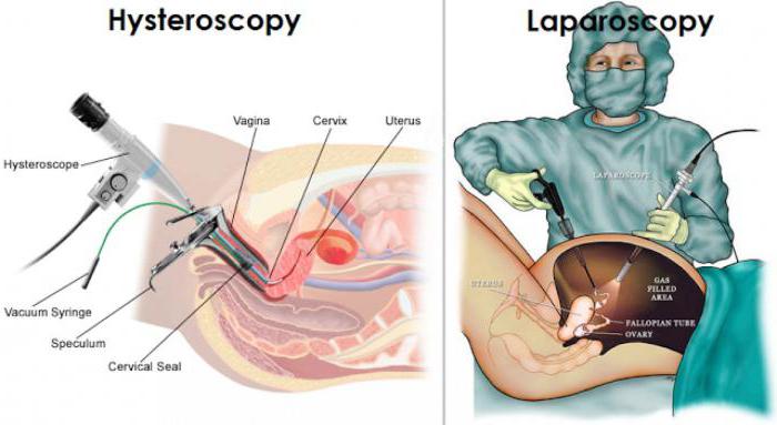 a laparoscopia e гистероскопия