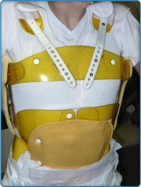 orthopedic thoracolumbar corset