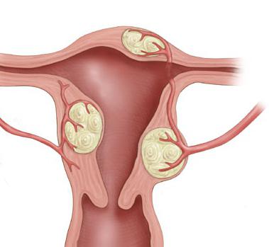 objawy mięśniaków macicy, jak rozpoznać