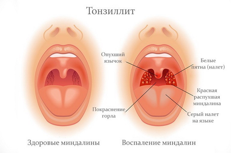 Chronic tonsillitis