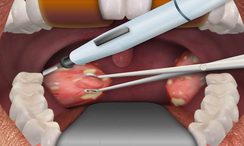 Removal of tonsils