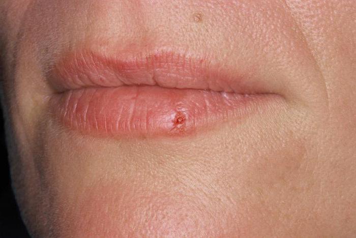 психосоматика el herpes labial en los labios