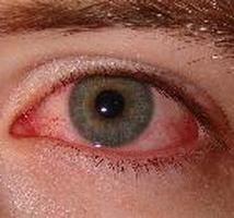 炎症的眼睛的虹膜