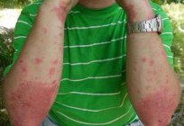 Alergia ao solário: possíveis causas, sintomas, diagnóstico e características de tratamento