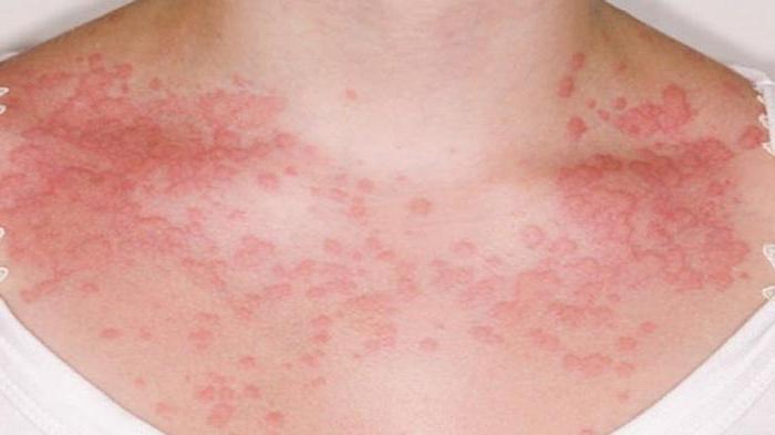 аллергия тәтті ересектерде белгілері