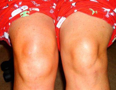 cyst Becker knee joint