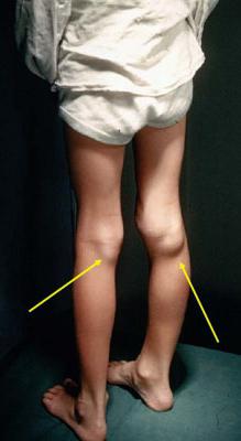 cyst Becker knee joint photo