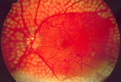 Hipertensiva ангиопатия de la retina