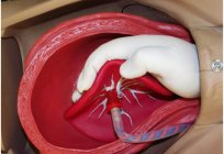 La separación manual de la placenta: métodos y la técnica de la ejecución