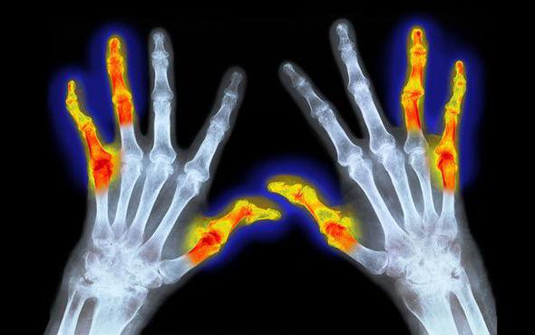 ICD 10 rheumatoid arthritis