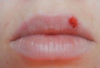 ポイントの赤い唇:原因や治療法