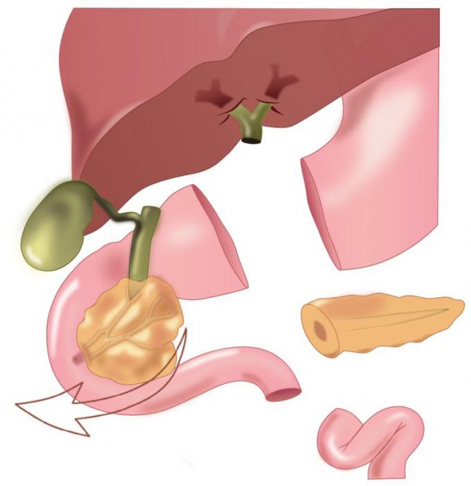 operation pancreatoduodenal resection