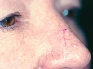 laser de remoção de vasos sanguíneos no rosto