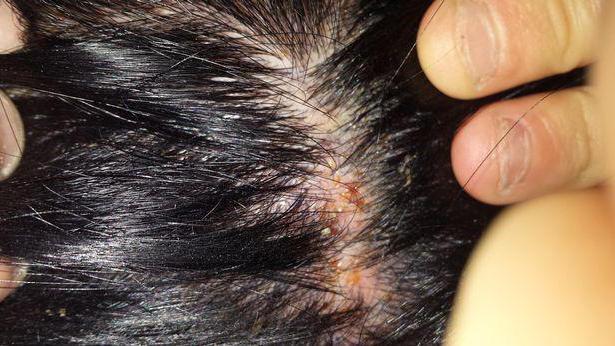 Allergy to hair dye symptoms