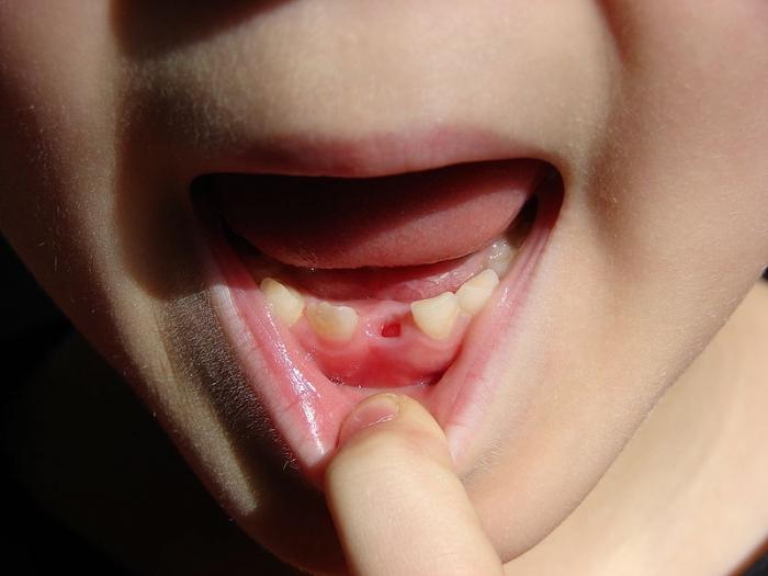 Порядок зміни зубів у дітей