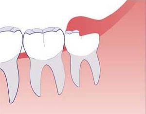 a remoção de um dente de sabedoria sobre o maxilar inferior