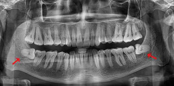 除去智歯と下顎の影響