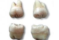 の除去智歯と下顎の特結果