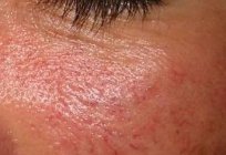 Unsightly rosacea, what is it?