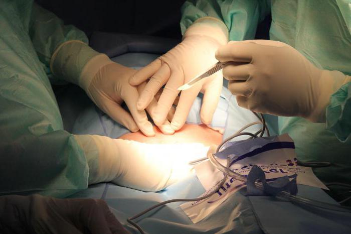 Operation zur Entfernung von myxome des Herzens