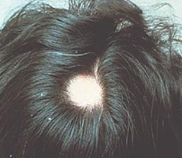 阿司匹林对头发的增长