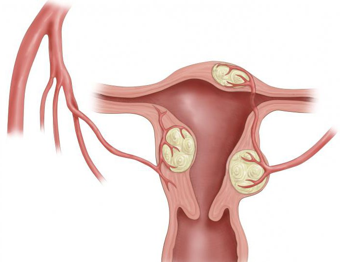 el Tratamiento de los miomas uterinos efectivamente remedios