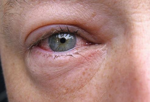 swelling of the eyes causes