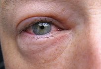 Jeśli stają się opuchnięte oczy, przyczyny mogą być różne. Odnosi się to zarówno do dorosłych jak i do dzieci
