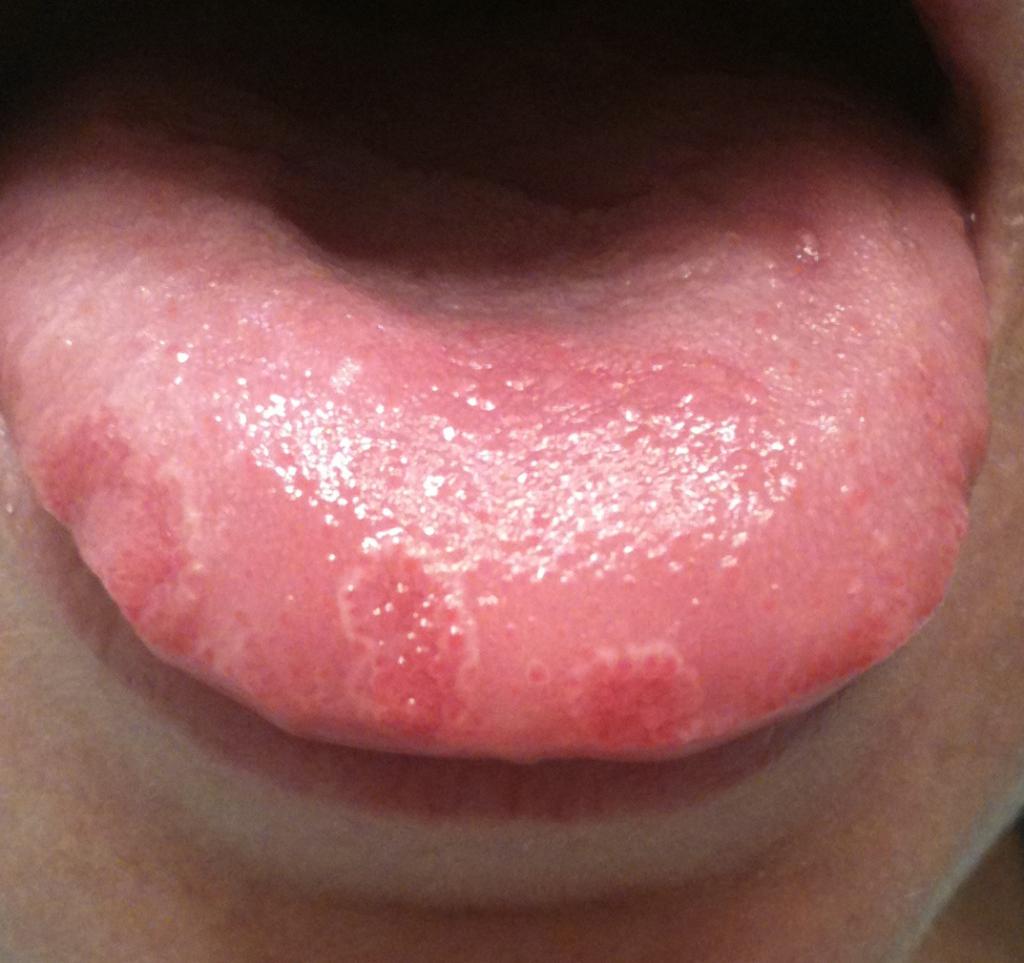 Pimples on the tongue
