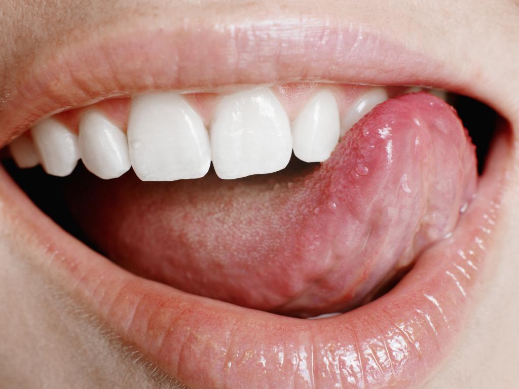 Ulcers on the tongue
