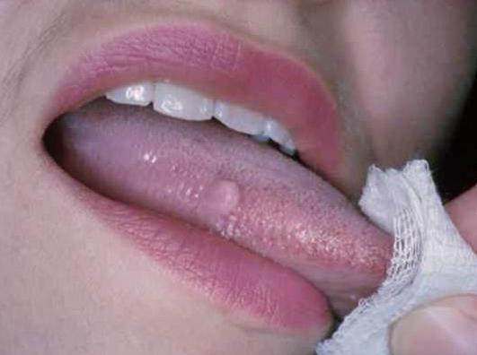 Papillom Mund-Behandlung