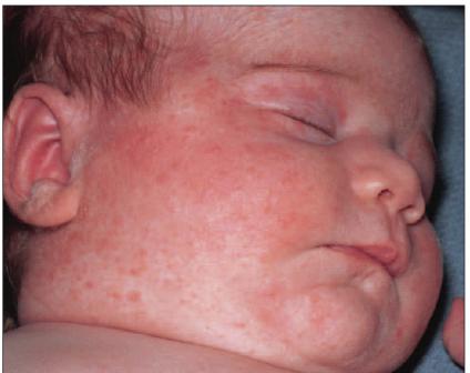 полицитемия en el recién nacido