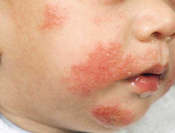 dermatite atópica a criança