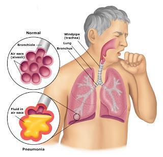 pneumonia интерстициальная