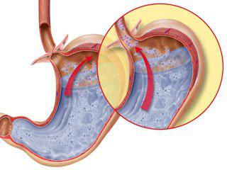 esophagitis insufficiency of the cardia