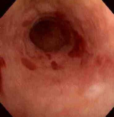la esofagitis ulcerosa