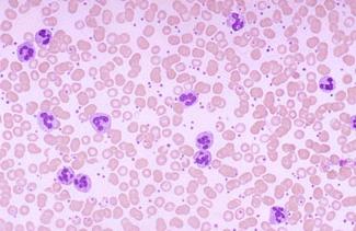 la leucocitosis en sangre de las causas de la