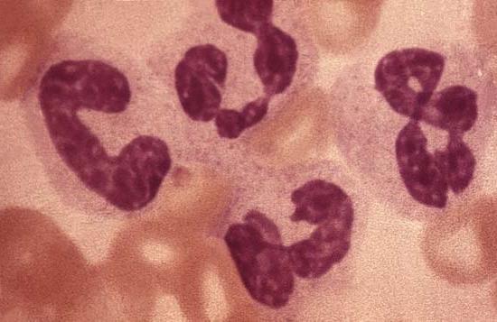 high leukocytosis in the blood