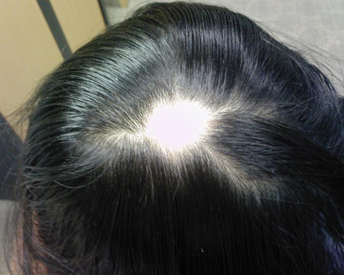 Haarausfall bei Frauen-Ursachen-Behandlung