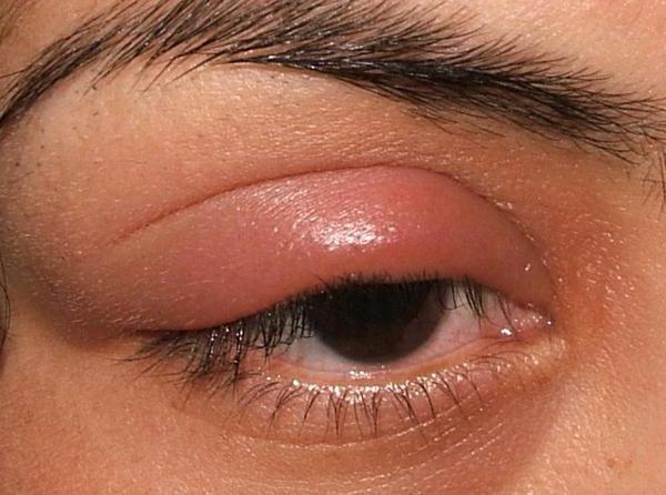 paraorbital血肿的眼睛